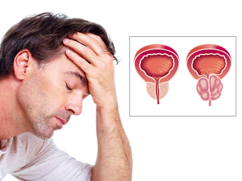 prostatako adenoma inpotentziarekin